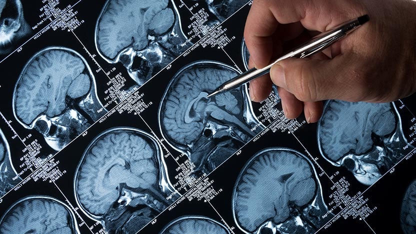 brain mri universal 15 Benefits of Marijuana That Can Improve Your Life