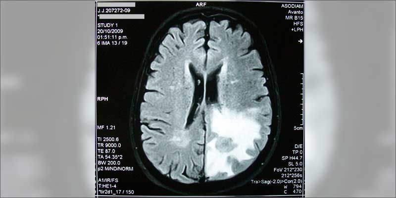 1 how cannabis treats brain cancer scan Get Ready Florida! Legal Weed Will Be Yours Next Week