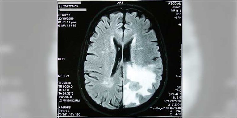 1 how cannabis treats brain cancer scan Will Cannabis Help Me Overcome My Public Speaking Anxiety?