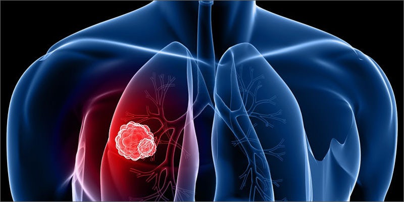 cannabis cures terminal stage iv lung cancer lung mass Miracle Cannabis Saved Her From Terminal Stage IV Lung Cancer