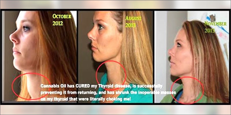 3 cannabis oil heals thyroid disease timeline Hillary Clinton Promised Bankers Shes Against Cannabis Legalization