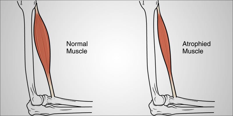 Cannabis Muscular Dystrophy 1 Muscular Dystrophy: 3 Ways Cannabis Can Ease The Symptoms Of MD