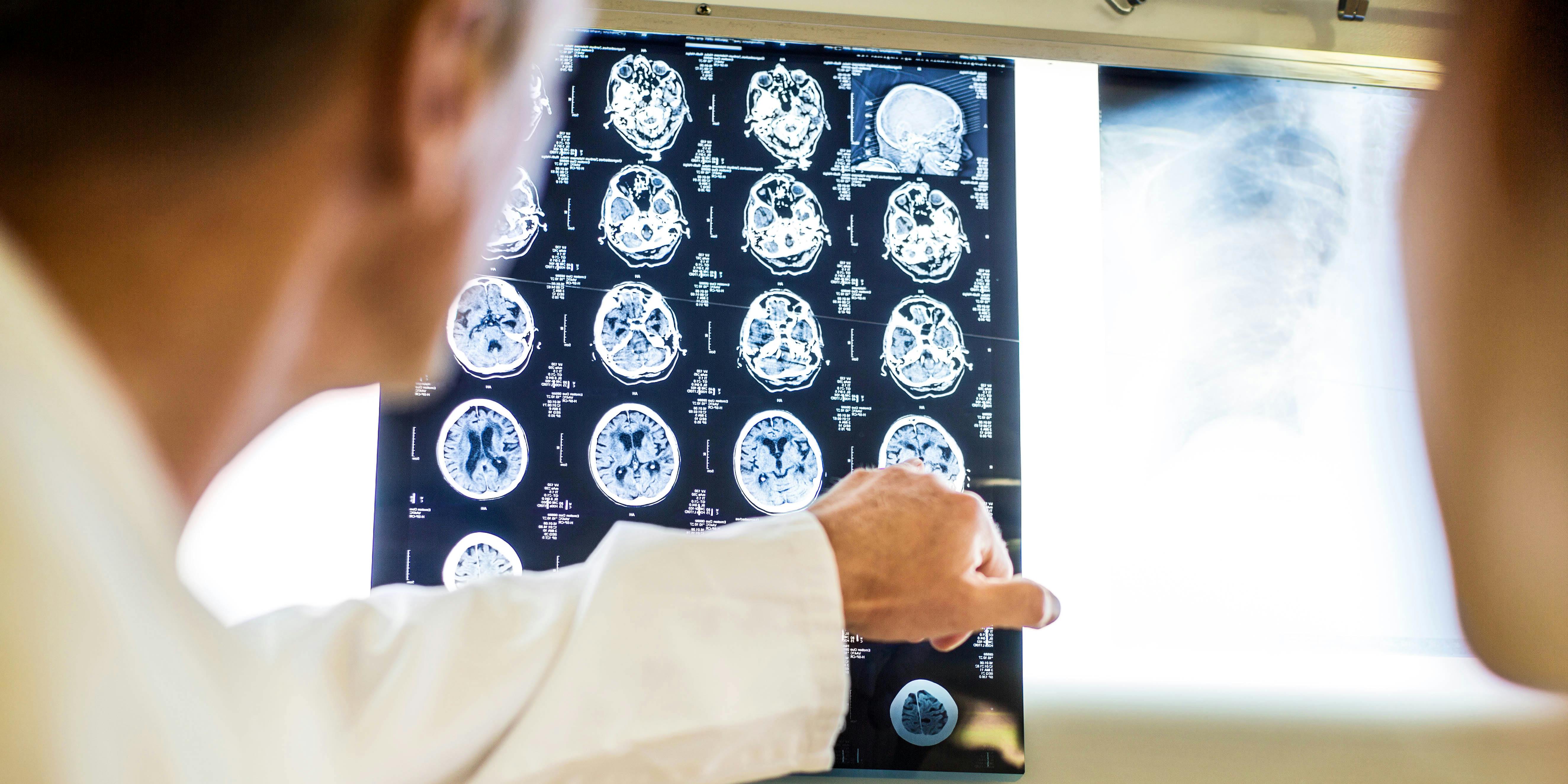 Medical technicians point at a patient's brain. A cannabis-based epilepsy treatment drug is now in the U.S. thanks to a young boy who suffered from seizures for years.